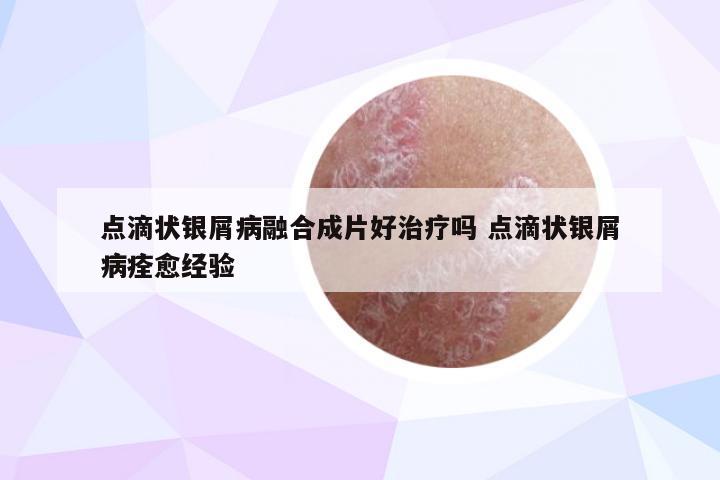 点滴状银屑病融合成片好治疗吗 点滴状银屑病痊愈经验