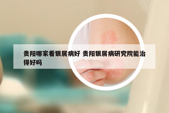 贵阳哪家看银屑病好 贵阳银屑病研究院能治得好吗