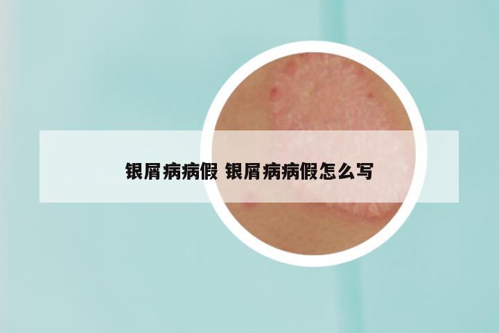 银屑病病假 银屑病病假怎么写