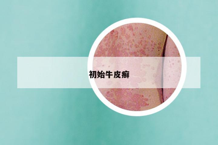初始牛皮癣