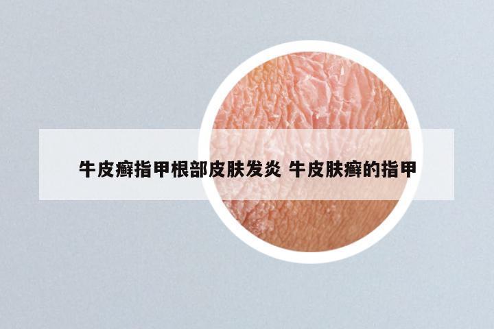 牛皮癣指甲根部皮肤发炎 牛皮肤癣的指甲