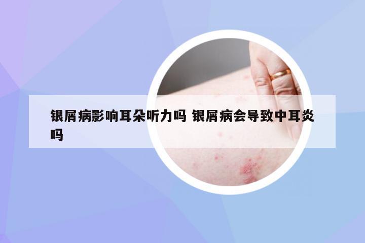 银屑病影响耳朵听力吗 银屑病会导致中耳炎吗