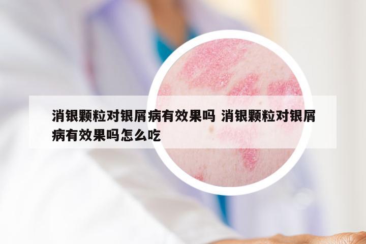 消银颗粒对银屑病有效果吗 消银颗粒对银屑病有效果吗怎么吃