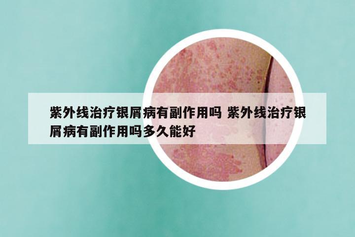 紫外线治疗银屑病有副作用吗 紫外线治疗银屑病有副作用吗多久能好