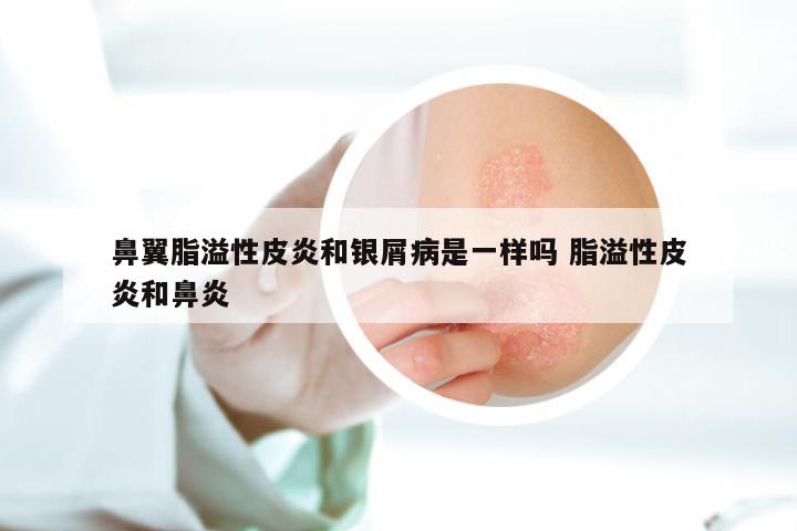 鼻翼脂溢性皮炎和银屑病是一样吗 脂溢性皮炎和鼻炎