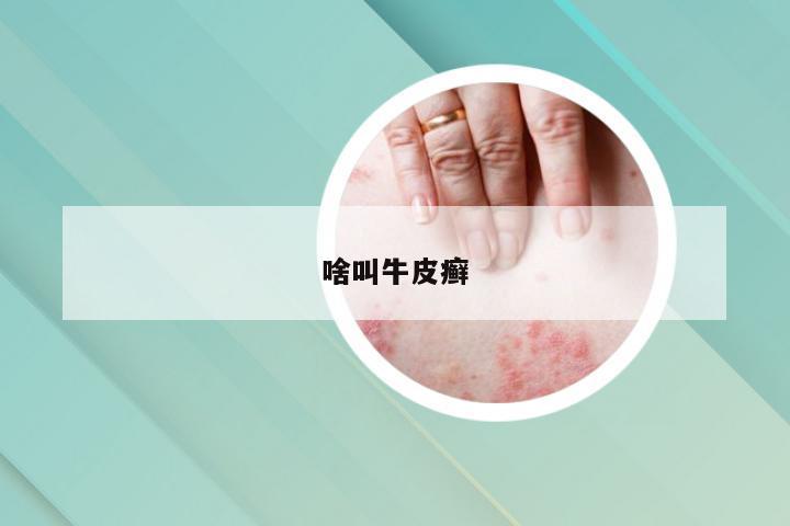 啥叫牛皮癣