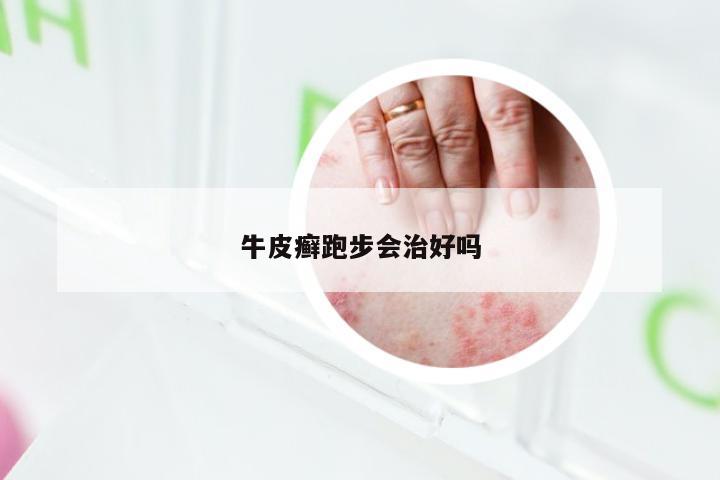 牛皮癣跑步会治好吗
