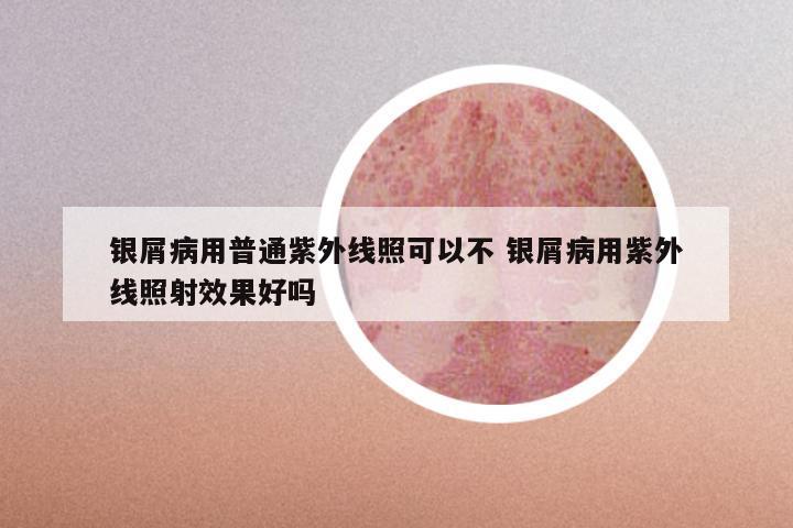 银屑病用普通紫外线照可以不 银屑病用紫外线照射效果好吗