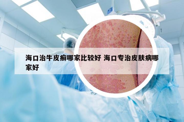 海口治牛皮癣哪家比较好 海口专治皮肤病哪家好