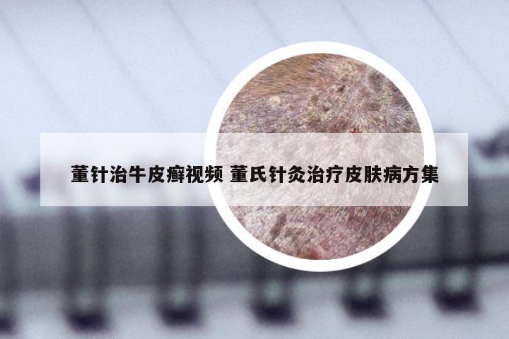 董针治牛皮癣视频 董氏针灸治疗皮肤病方集