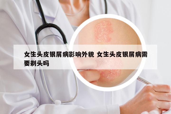 女生头皮银屑病影响外貌 女生头皮银屑病需要剃头吗