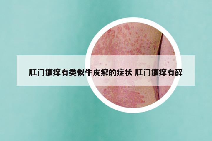 肛门瘙痒有类似牛皮癣的症状 肛门瘙痒有藓