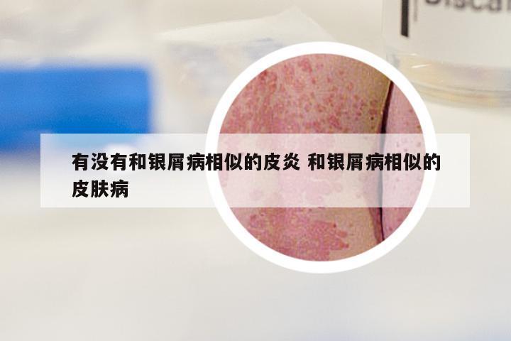 有没有和银屑病相似的皮炎 和银屑病相似的皮肤病
