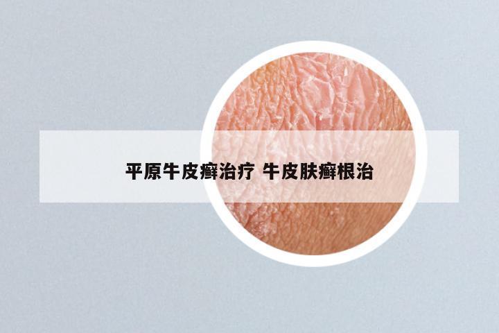 平原牛皮癣治疗 牛皮肤癣根治