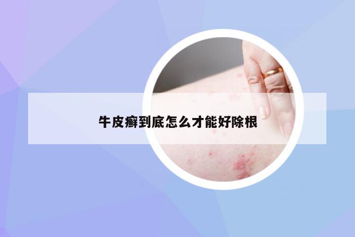 牛皮癣到底怎么才能好除根