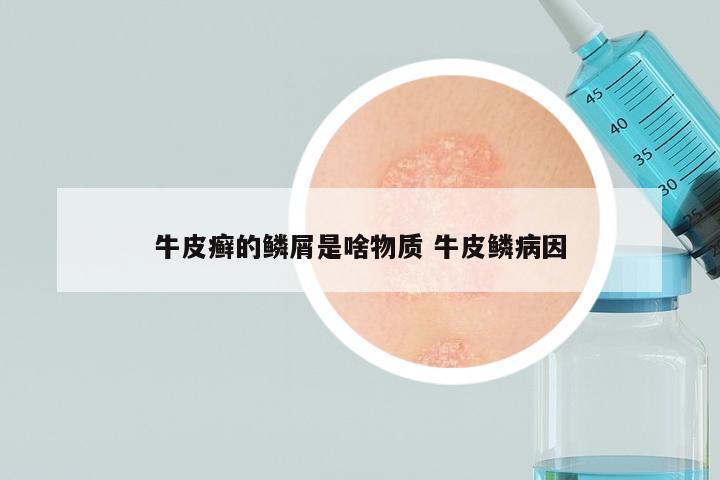牛皮癣的鳞屑是啥物质 牛皮鳞病因