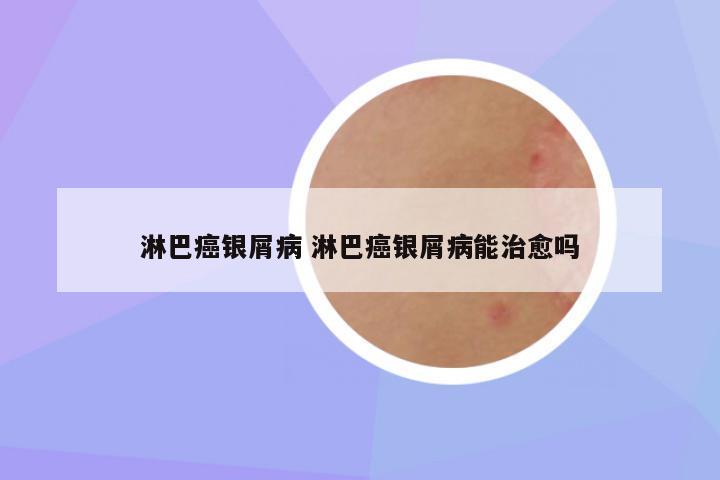 淋巴癌银屑病 淋巴癌银屑病能治愈吗