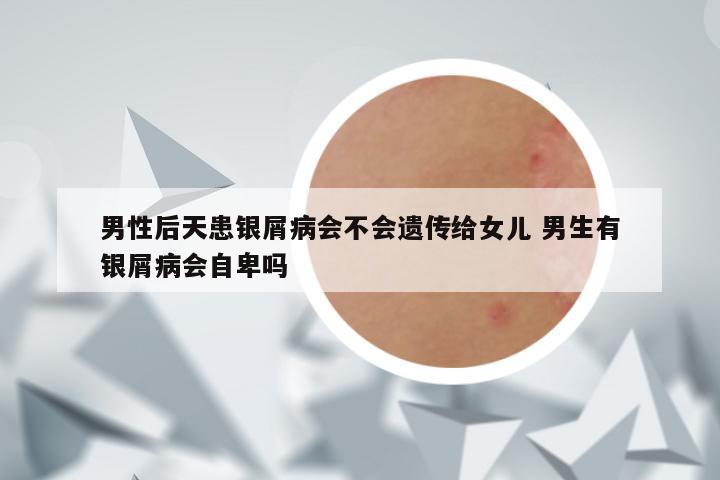 男性后天患银屑病会不会遗传给女儿 男生有银屑病会自卑吗