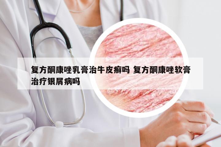 复方酮康唑乳膏治牛皮癣吗 复方酮康唑软膏治疗银屑病吗