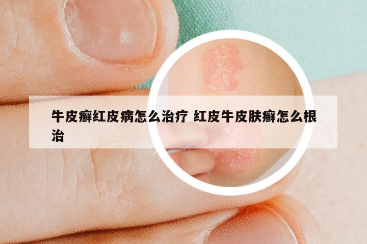 牛皮癣红皮病怎么治疗 红皮牛皮肤癣怎么根治