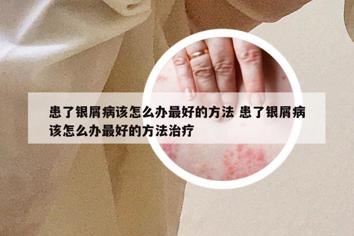 患了银屑病该怎么办最好的方法 患了银屑病该怎么办最好的方法治疗