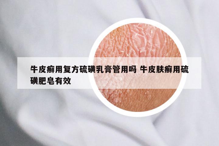 牛皮癣用复方硫磺乳膏管用吗 牛皮肤癣用硫磺肥皂有效