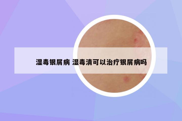 湿毒银屑病 湿毒清可以治疗银屑病吗