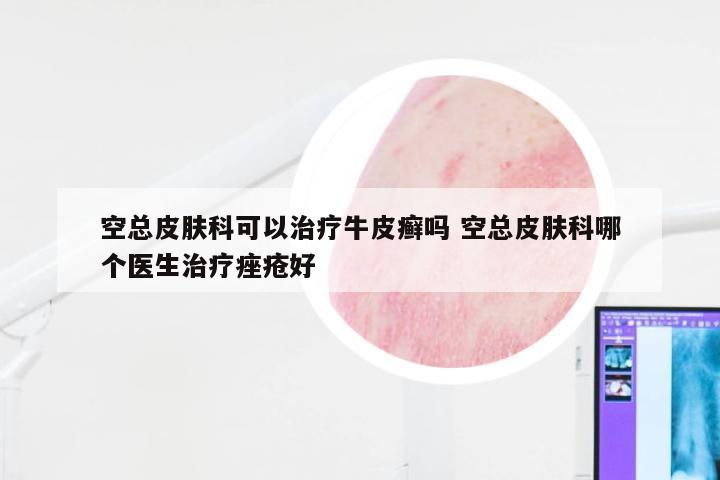 空总皮肤科可以治疗牛皮癣吗 空总皮肤科哪个医生治疗痤疮好