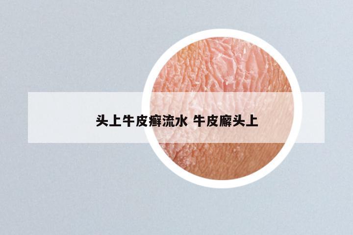 头上牛皮癣流水 牛皮廨头上