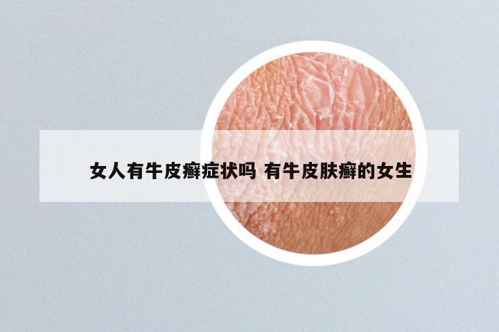 女人有牛皮癣症状吗 有牛皮肤癣的女生