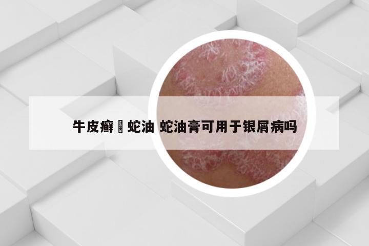 牛皮癣抺蛇油 蛇油膏可用于银屑病吗