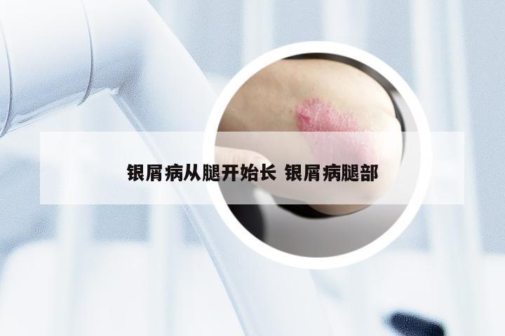 银屑病从腿开始长 银屑病腿部