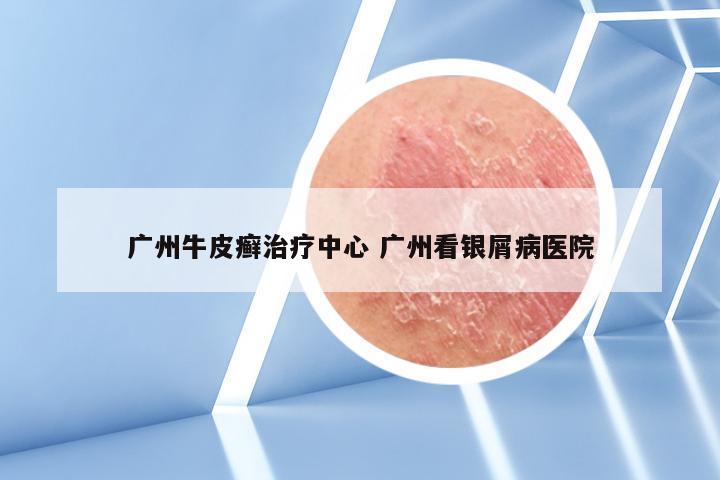 广州牛皮癣治疗中心 广州看银屑病医院
