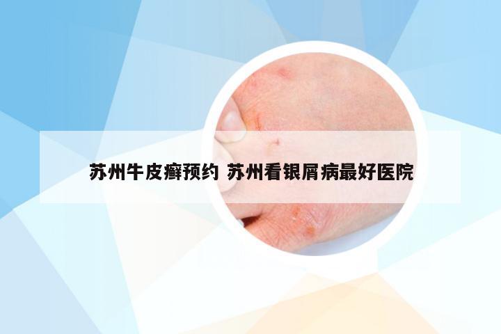 苏州牛皮癣预约 苏州看银屑病最好医院