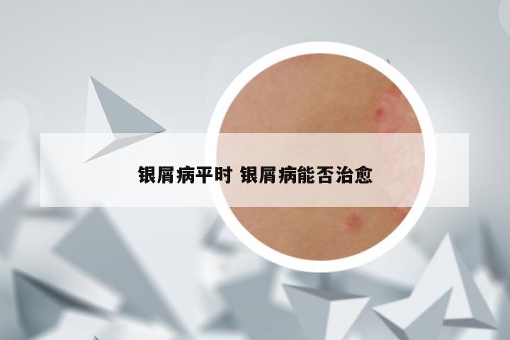 银屑病平时 银屑病能否治愈
