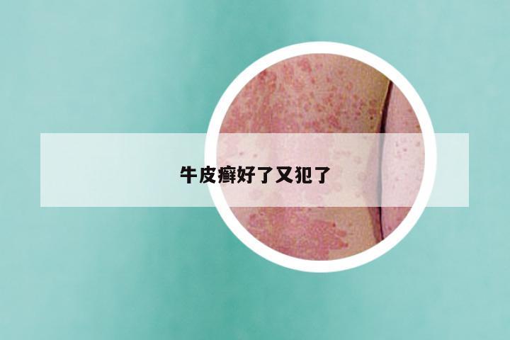 牛皮癣好了又犯了