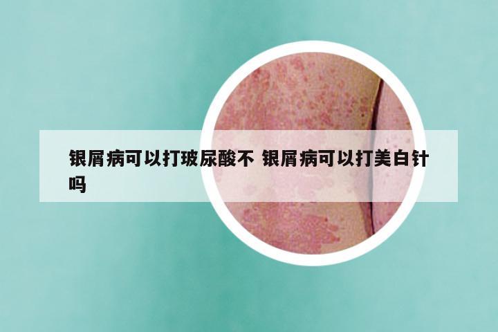 银屑病可以打玻尿酸不 银屑病可以打美白针吗
