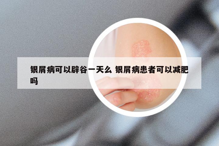 银屑病可以辟谷一天么 银屑病患者可以减肥吗