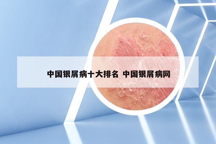 中国银屑病十大排名 中国银屑病网