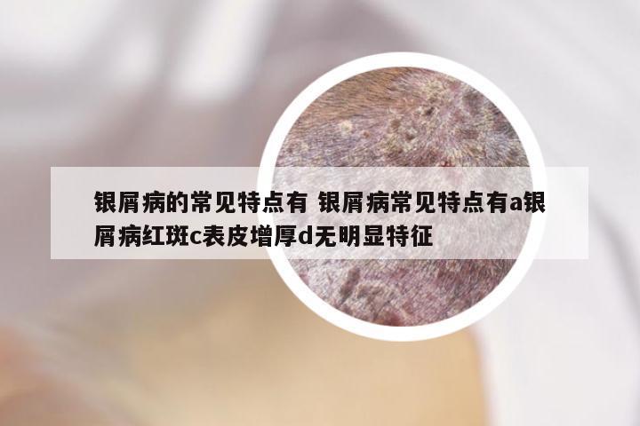 银屑病的常见特点有 银屑病常见特点有a银屑病红斑c表皮增厚d无明显特征