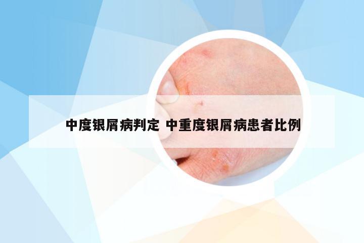 中度银屑病判定 中重度银屑病患者比例