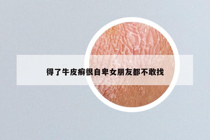 得了牛皮癣很自卑女朋友都不敢找
