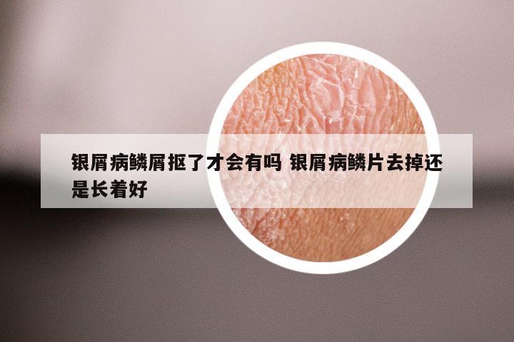 银屑病鳞屑抠了才会有吗 银屑病鳞片去掉还是长着好