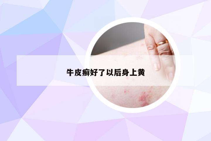 牛皮癣好了以后身上黄