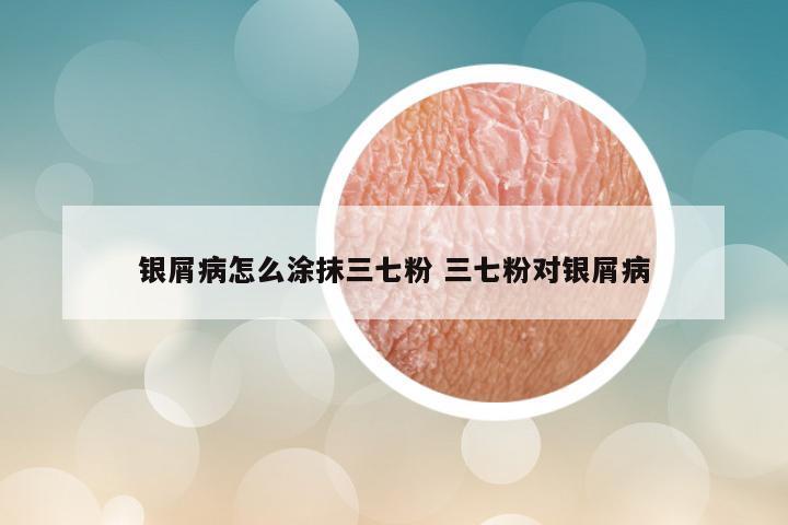 银屑病怎么涂抹三七粉 三七粉对银屑病