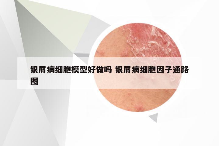银屑病细胞模型好做吗 银屑病细胞因子通路图
