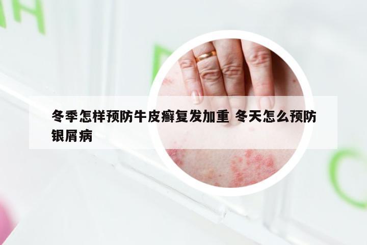 冬季怎样预防牛皮癣复发加重 冬天怎么预防银屑病