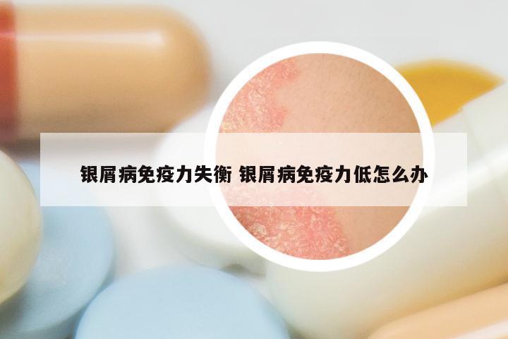 银屑病免疫力失衡 银屑病免疫力低怎么办
