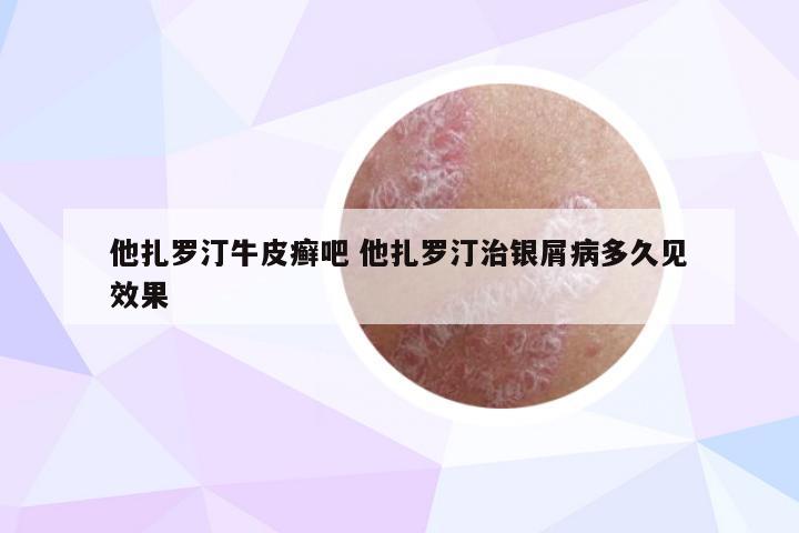他扎罗汀牛皮癣吧 他扎罗汀治银屑病多久见效果