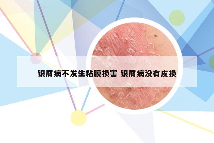 银屑病不发生粘膜损害 银屑病没有皮损